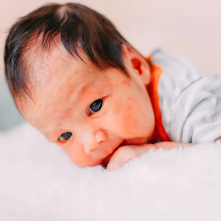 صورة لمولود مصاب بالطفح الجلدي