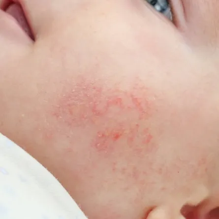 صورة لوجه طفل مصاب بالأكزيما