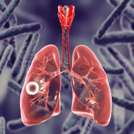 مرض الدرن - الصورة من icloudhospital