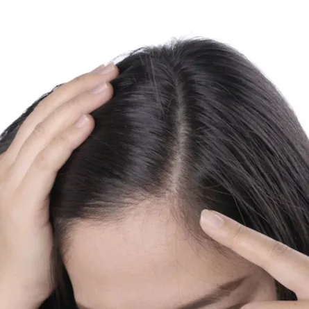 انواع القشرة واسبابها