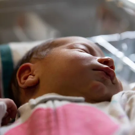 صورة لمولود يعاني من اليرقان