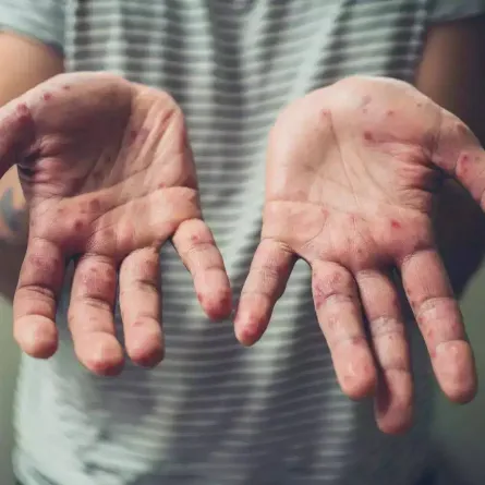 جدري القردة. الصورة من "وام"