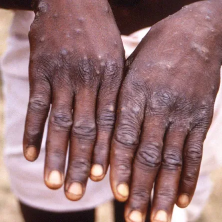 صورة مصاب بجدري القرود