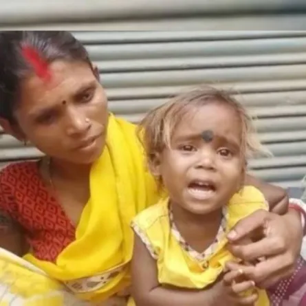 معاناة طفلة هندية ولدت بأطراف زائدة