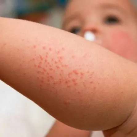 صورة لطفل رضيع يعاني من مرض جلدي