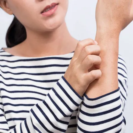 صورة لحامل تعاني من الإكزيما