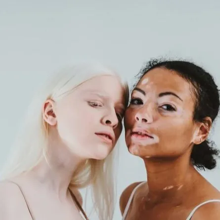 الفرق بين المهق والبهاق