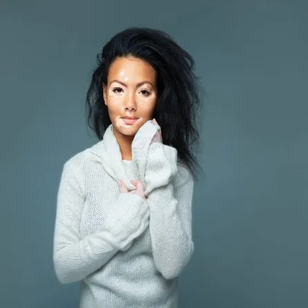 أبرز المعلومات عن مرض البهاق، في اليوم العالمي للبهاق