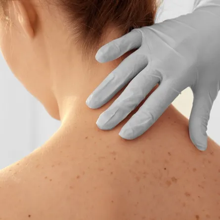 سرطان الجلد: غالباً ما يتم إغفال تطبيق الحماية على هذه المنطقة