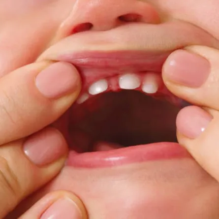 صورة لبداية ظهور الأسنان اللبنية