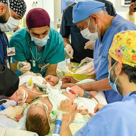 نجاح عملية فصل التوأم اليمني "مودة ورحمة" دون مضاعفات