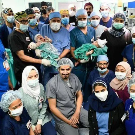 نجاح فصل التوأم السيامي اليمني مودة ورحمة وتحقيق إنجازات جديدة 