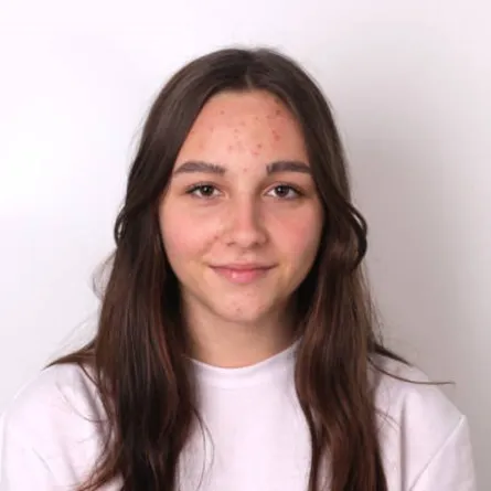 صورة لفتاة لديها بلوغ مبكر