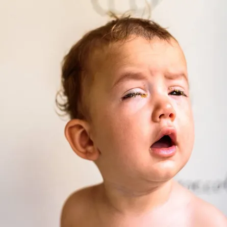 صورة لطفل مريض بالرمد