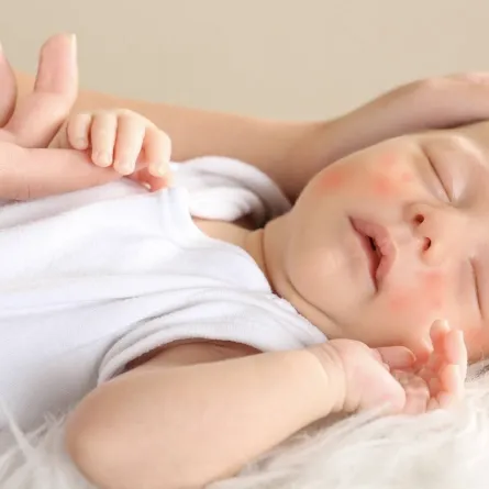 صورة لطفل مريض بمرض جلدي