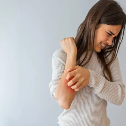 علاج الإكزيما بالأعشاب هل هو ممكن؟.. طبيب يجيب