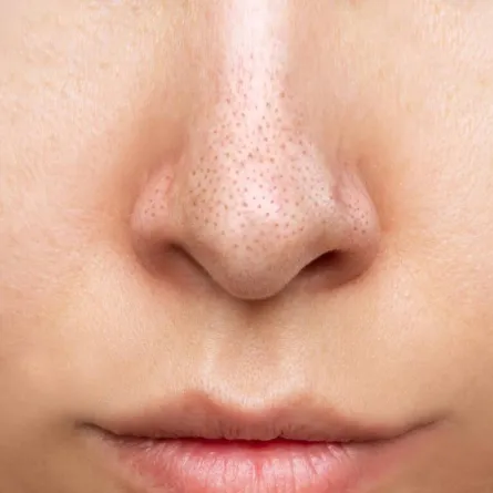 إزالة الرؤوس السوداء من الوجه في 10 دقائق فقط