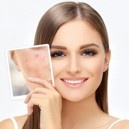 حب الشباب أنواعه وطرق علاجه Acne Treatments