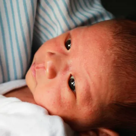 صورة لحبوب حمراء ظهرت على وجه المولود