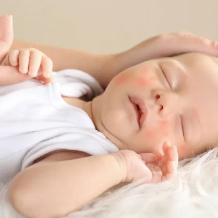 صورة لجفاف بشرة المولود