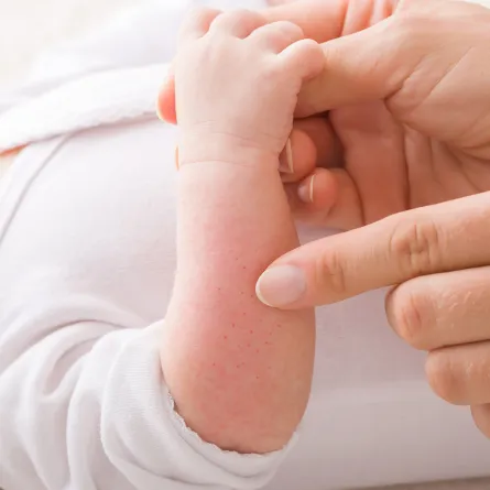 أسباب انتشار حبوب صغيرة في جسم طفلي