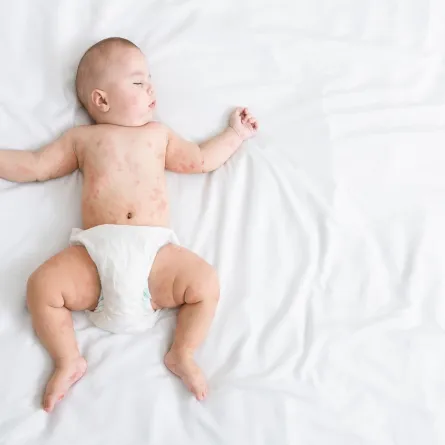 صورة لطفل رضيع نائم يعاني من الطفح الجلدى