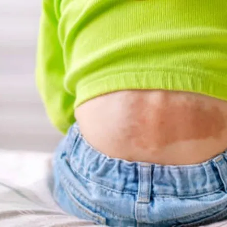 صورة للبقع المنغولية