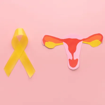 صورة لتكيس المبايض