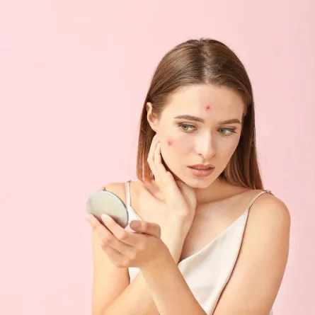 علاج البثور