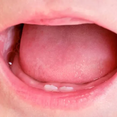 صورة تشير لظهور القواطع السفلية