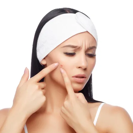 علاج حب الشباب بالثوم.. هل يفيد حقاً؟