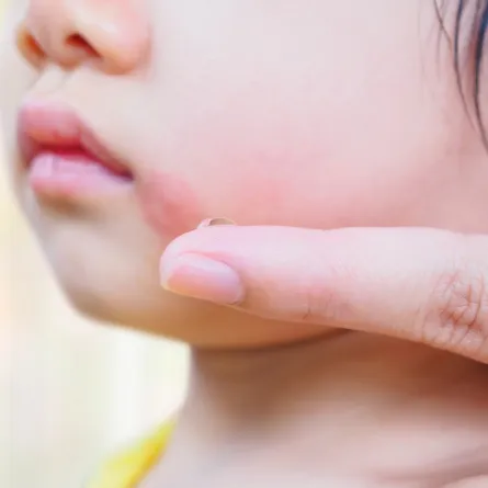 صورة لطفل مصاب بدمل