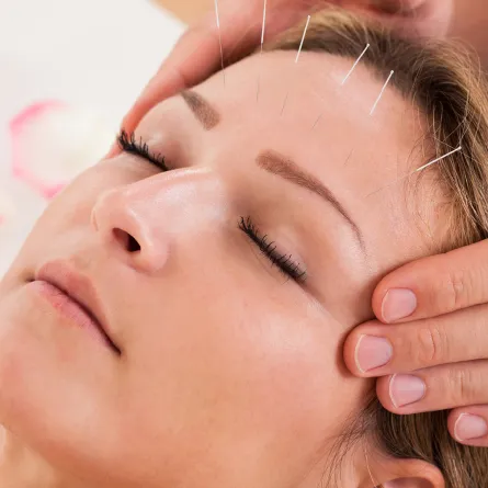 الوخز بالإبر الصينية أشهر علاجات تسكين الآلام