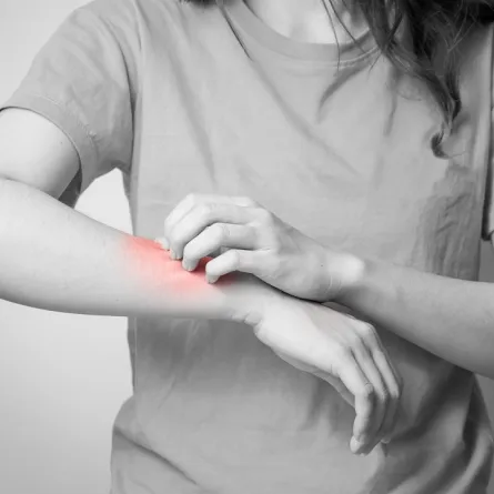 صورة لامرأة مصابة بالحساسية