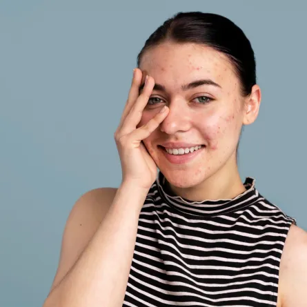 فوائد البنزويل بروكسيد لحب الشباب 