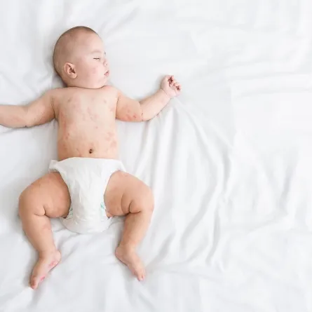 صورة لطفل رضيع يعاني من الطفح الجلدي 