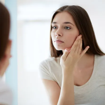 كيفية علاج حب الشباب حول الفم بطرق فعالة - Shutterstock