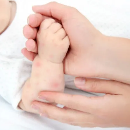 صورة لحساسية الحرارة أو حمو النيل عند الرضع