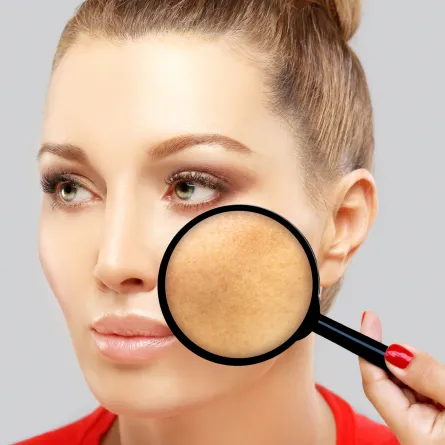 كيفية التخلص من البقع الداكنة على بشرتك