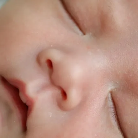 صورة تشير لبعض البثور في وجه المولود