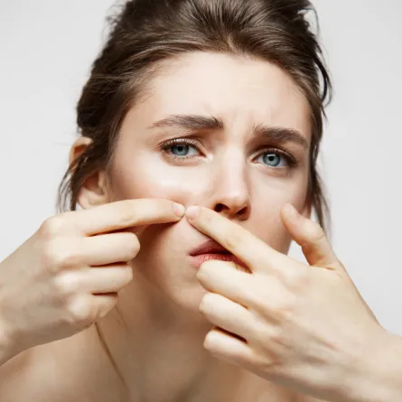 حب الشباب الناتج عن التقلبات الهرمونية يحتاج لعلاج طبي- المصدر freepik