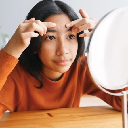 صورة لطفلة تعاني من حب الشباب