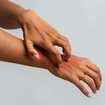 صورة لامراة تعاني من الحكة