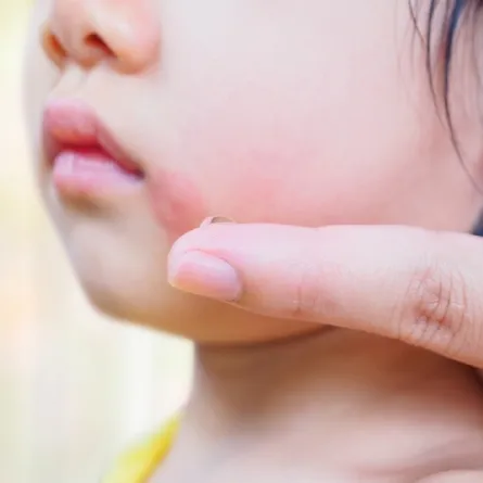 صورة لطفل يعاني من الحساسية