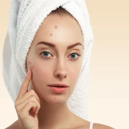 صورة لامرأة يظهر على وجهها حب الشباب