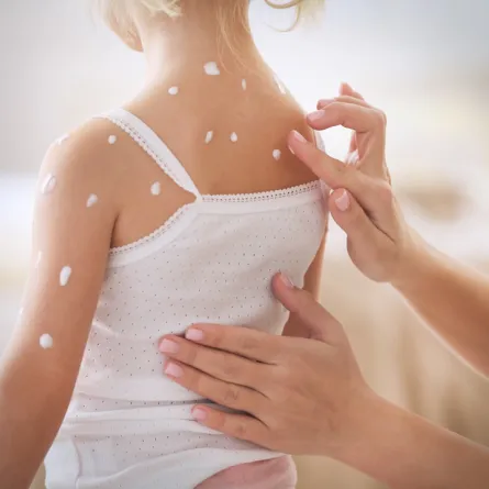 صورة لأم تضع الكريم لابنتها