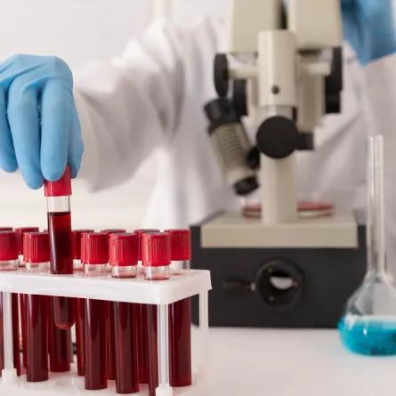 لا يتم اكتشاف حموضة الدم إلا بالتحاليل 