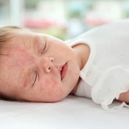 صورة لطفل مصاب بحكة جلدية