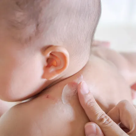 لدغات البعوض