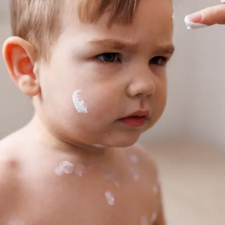 صورة الحساسية الجلدية لدى الطفل